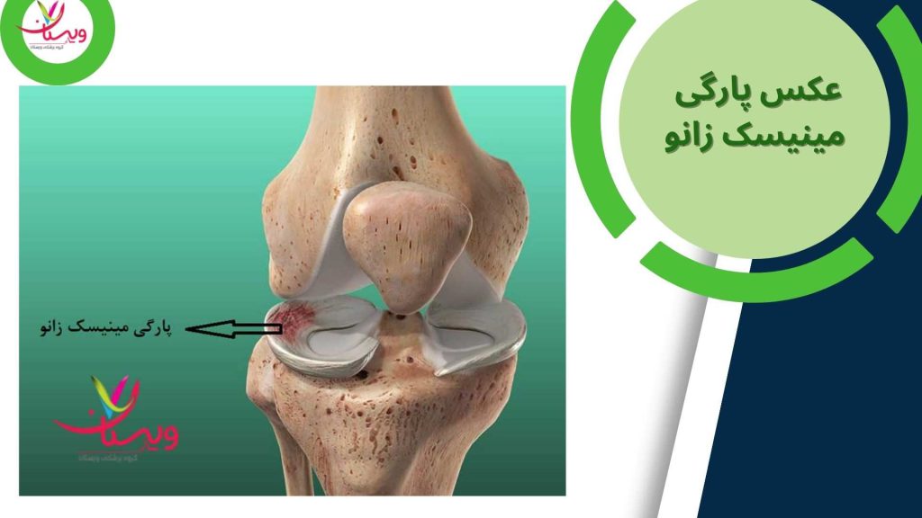 فیزیوتراپی پارگی مینیسک زانو
