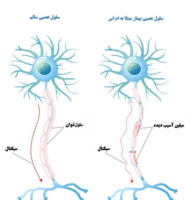 تشخیص ام اس متخصص نورولوژی
