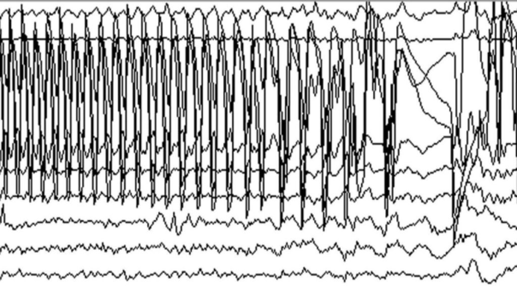 EEG نتایج فوری ارائه میدهد. عکس نوار مغز ناسالم