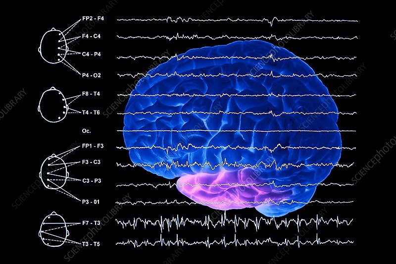EEG میتواند فعالیت مغزی طبیعی و غیرطبیعی را مقایسه کند. عکس نوار مغز در همچنین در کلینیکهای تخصصی کاربرد دارد.