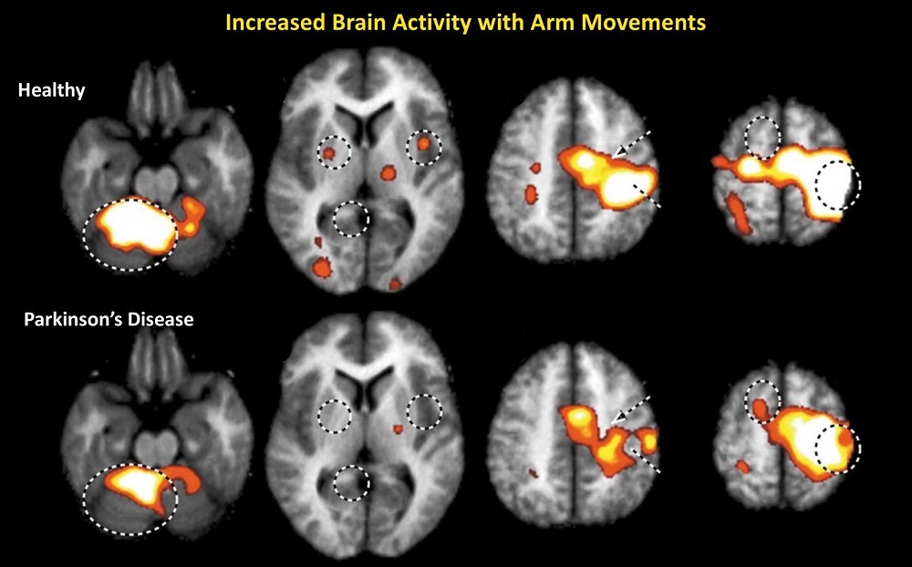 با MRI به تشخیص بیماری کمک کرد. عکس MRI از مغز سر