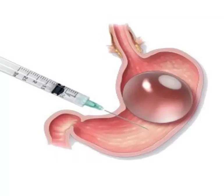 چه کسی می تواند بوتاکس معده داشته باشد؟ برای دستیابی به نتیجه مطلوب ممکن است شما نیاز به تزریق 2 یا 3 بوتاکس داشته باشید