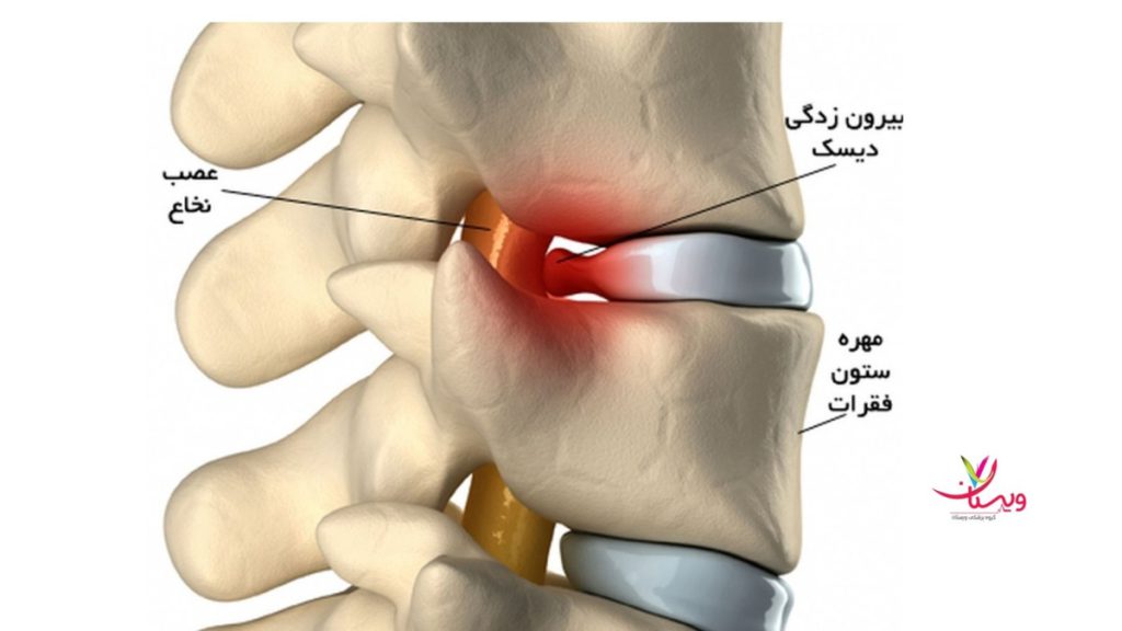 بیرونزدگی دیسک کمر روش درمان بیرون زدگی دیسک کمر