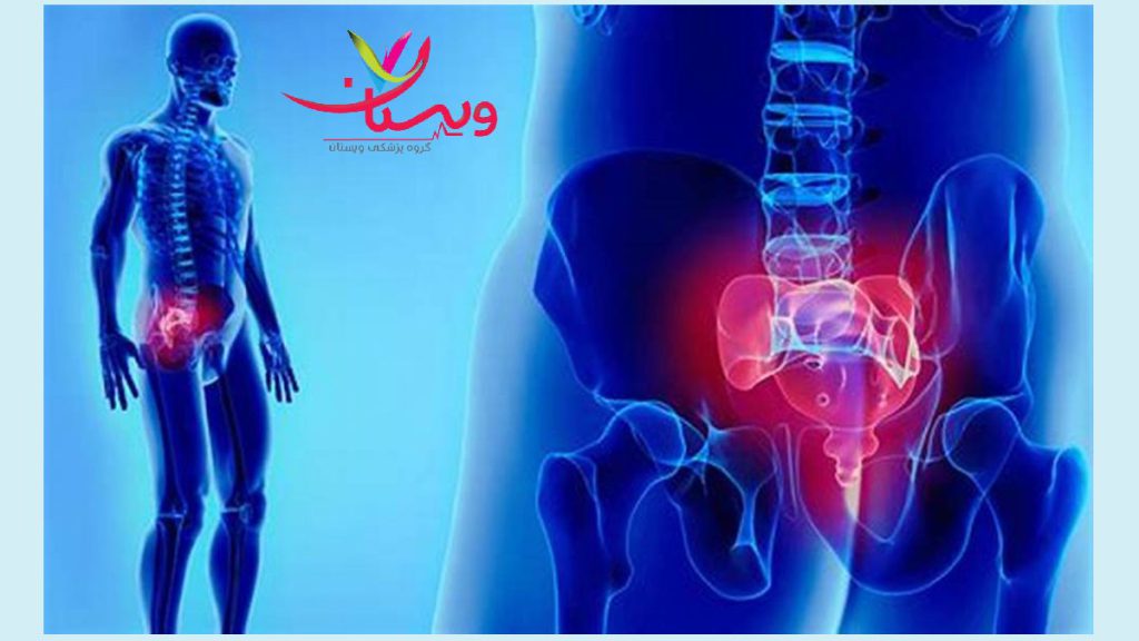 سوزندرمانی خشک پیریفورمیس: تسکین درد عصب سیاتیک اقایی که دچار درد پیریفورمیس شده است