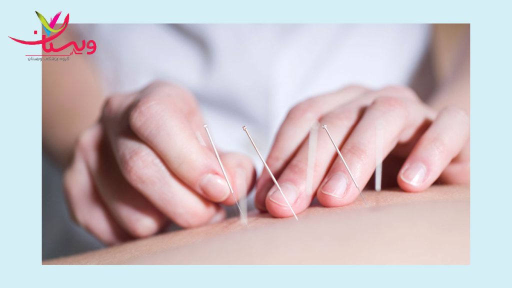 تکنیک درای نیدلینگ کمر پزشک در حال انجام درای نیدلینگ برای کمر بیمار است