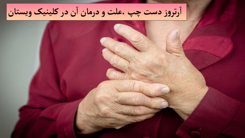 آرتروز دست چپ یک خانم که به آرتروز دست چپ مبتلا شده است