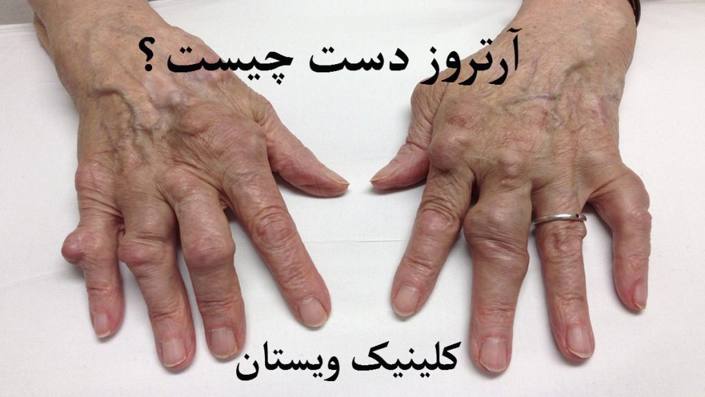 آرتروز دست دسنهای یک شخص که به آرتروز مبتلا شده است