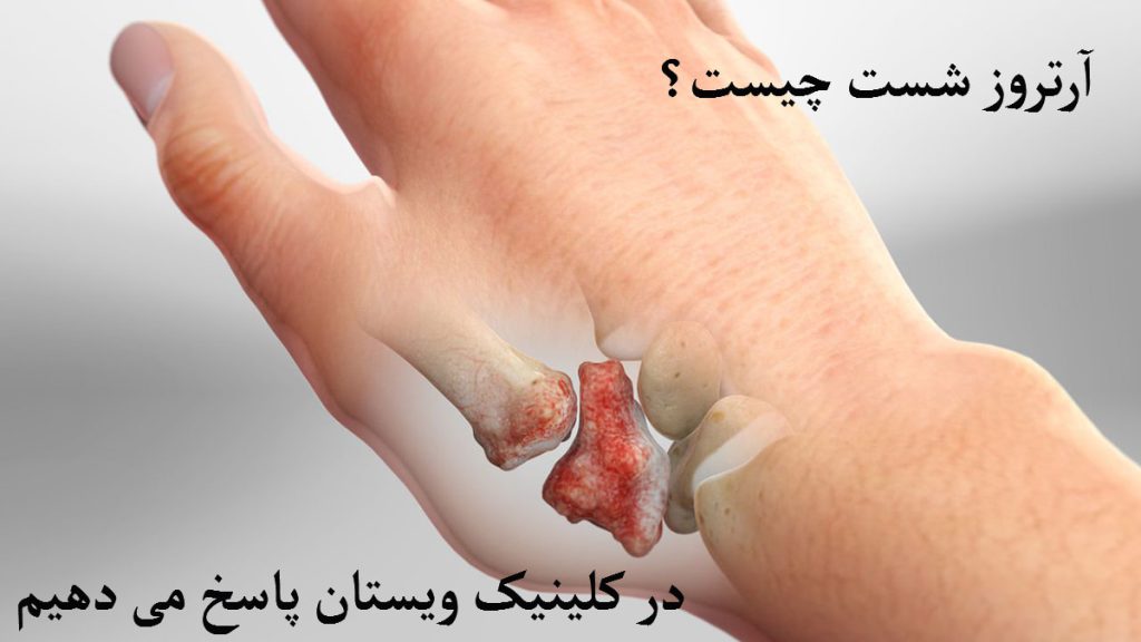 آرترزو شست دست یک دست که استخوتن قسمت شست آن به طور مشخص نشان داده شده است