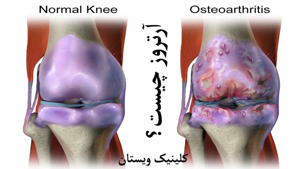 آرتروز زانو دو مفصل زانوی سالم و مفصل دارای آرتروز
