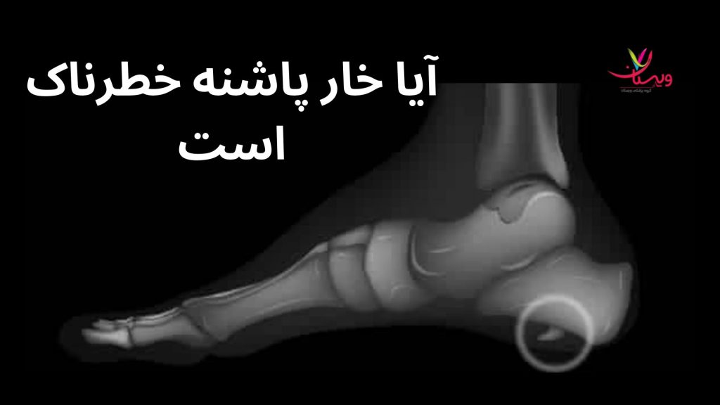 خار پاشنه خطرناک نیست آیا خار پاشنه خطرناک است