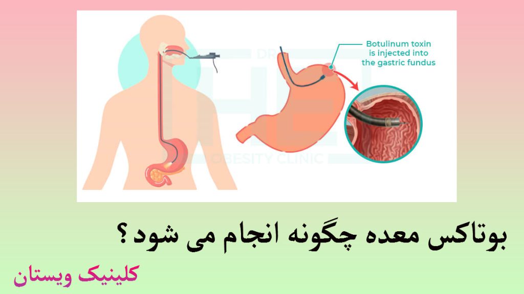 بوتاکس معده یک شخص که دستگاه آندوسکوپی در دهان او است-یک معده که در حال تزریق بوتاکس می باشد