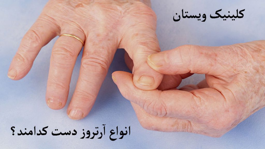 انواع آرتروز دست دستهای شخصی که به آرتروز انگشت مبتلا شده است