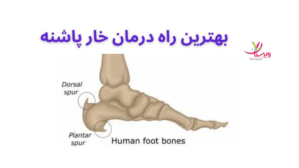 بهترین روش درمان خارپاشنه جراحی خارپاشنه بهترین راه درمان