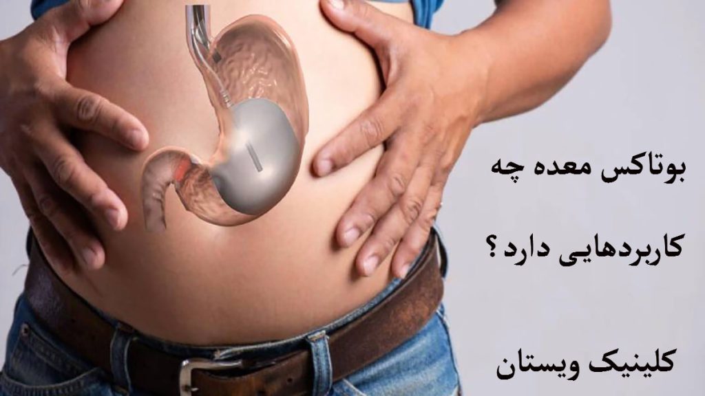 کاربرد بوتاکس معده یک شخص چاق که معده او بصورت مشخص نشان داده شده است