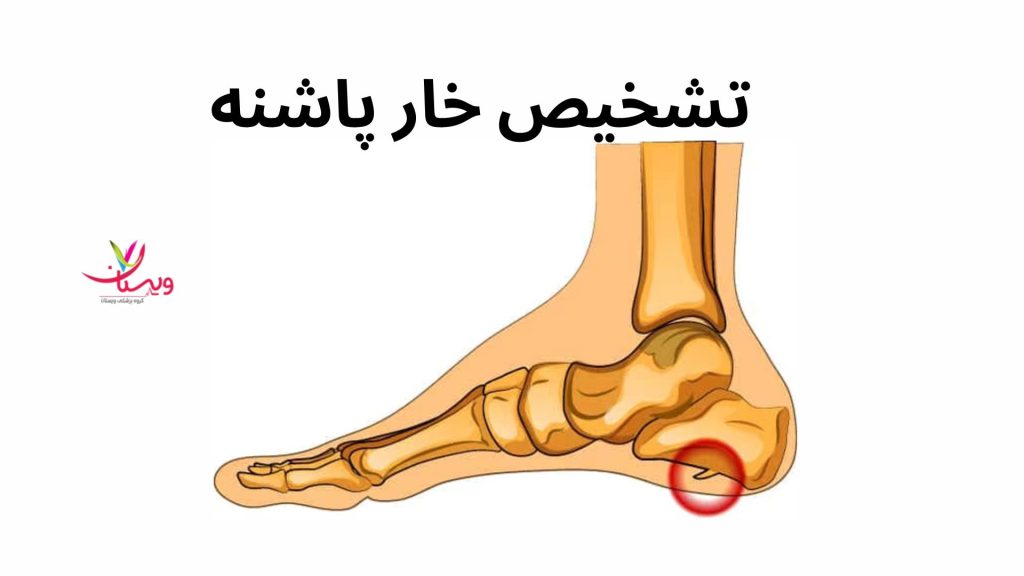 تشخیص خارپاشنه با عکس تشخیص خار پاشنه چگونه است