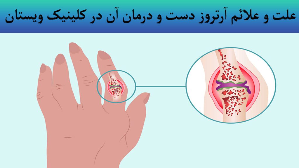 دست یک شخص که در قسمت انگشت به آرتروز دست مبتلا شده است