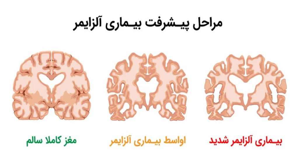 از دست دادن مهارتهای حرکتی ناتوانی در ارتباط برقرار کردن