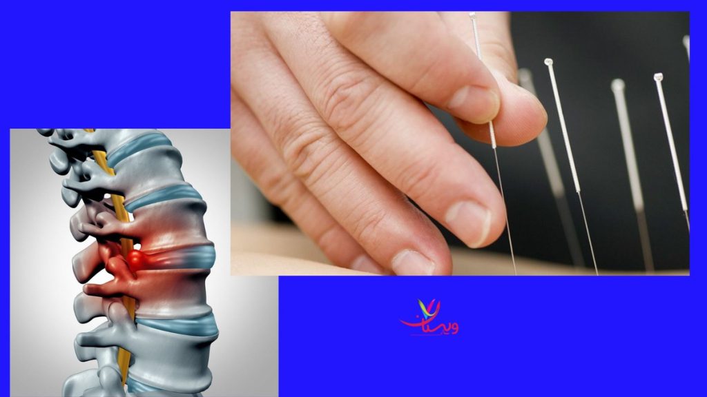 فتق دیسک علائم بیرون زدگی دیسک کمر