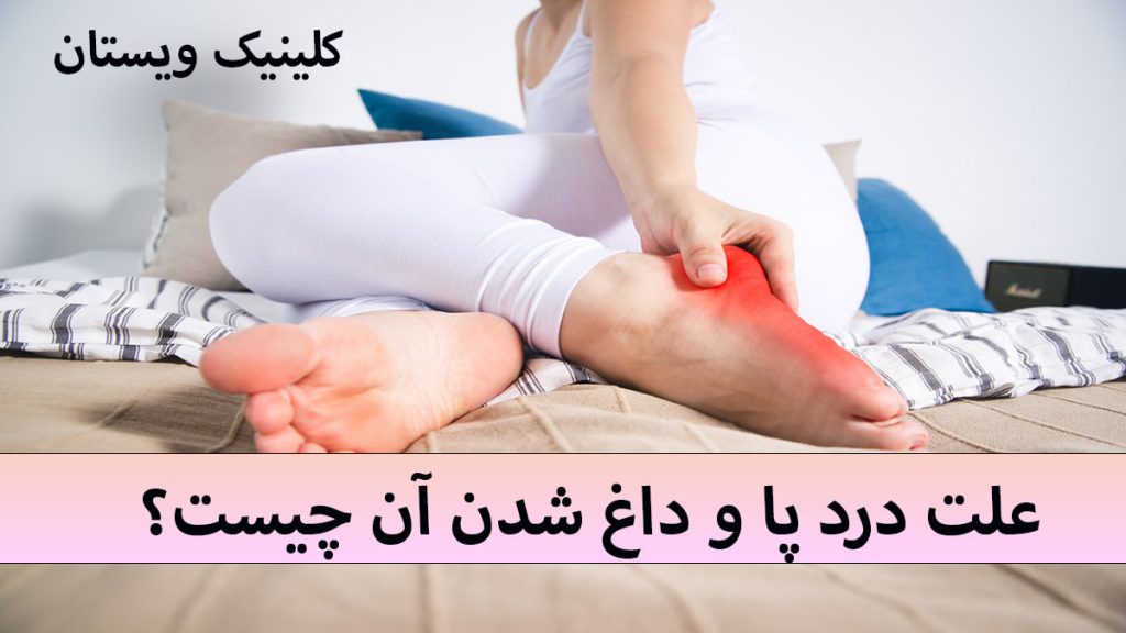 یک خانم که نشسته است و داغ شدن و سوزش پا دارد