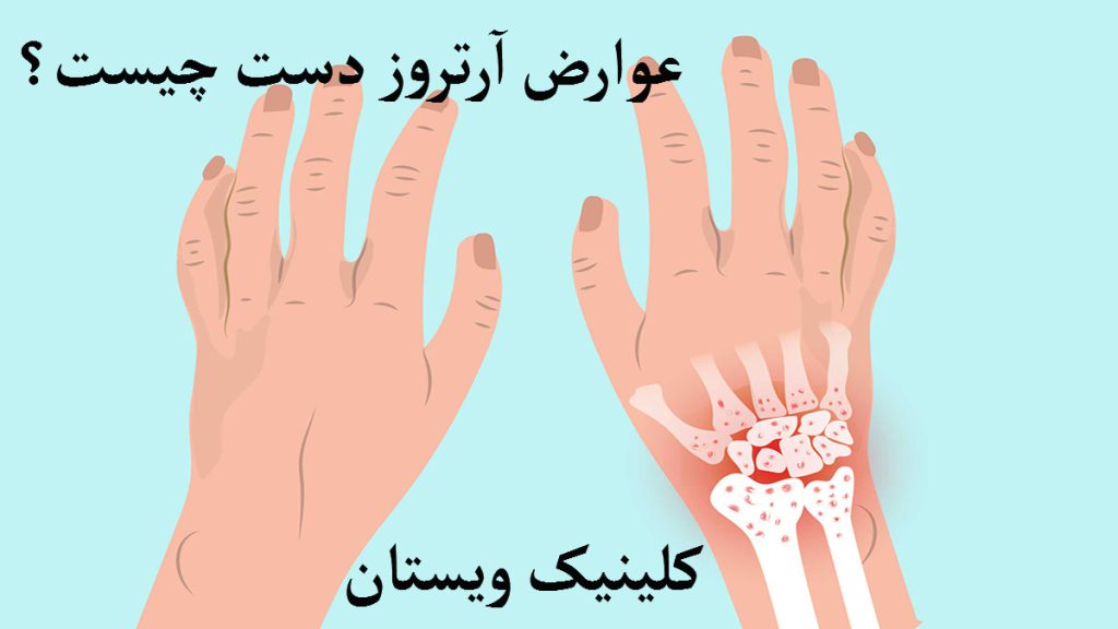 عوارض آرتروز دستهای یک شخص که استخوان یکی از انها برای نمایش دقیق آرتروز به صورت مشخص نشان داده می شود