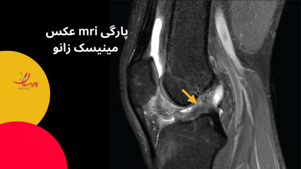 مفصل زانو عکس mri پارگی مینیسک زانو