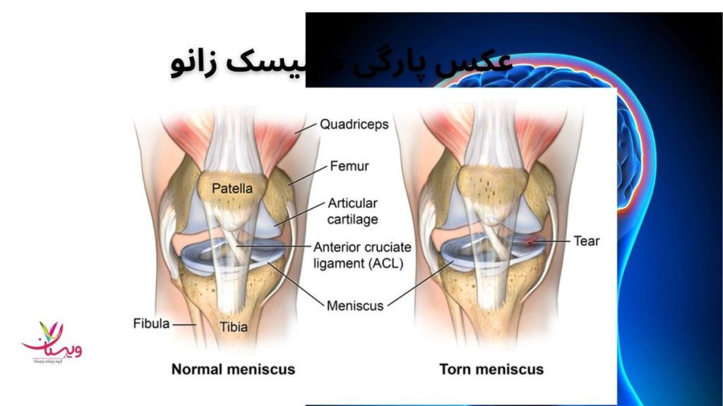 پاره شدن مینیسک زانو عکس پارگی مینیسک زانو