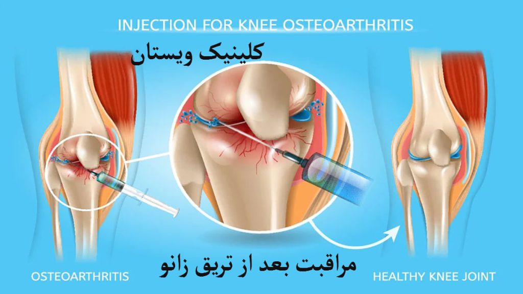 مراقبت های بعد از تزریق کورتون سه تصویر از مفصل زانو در کنار هم