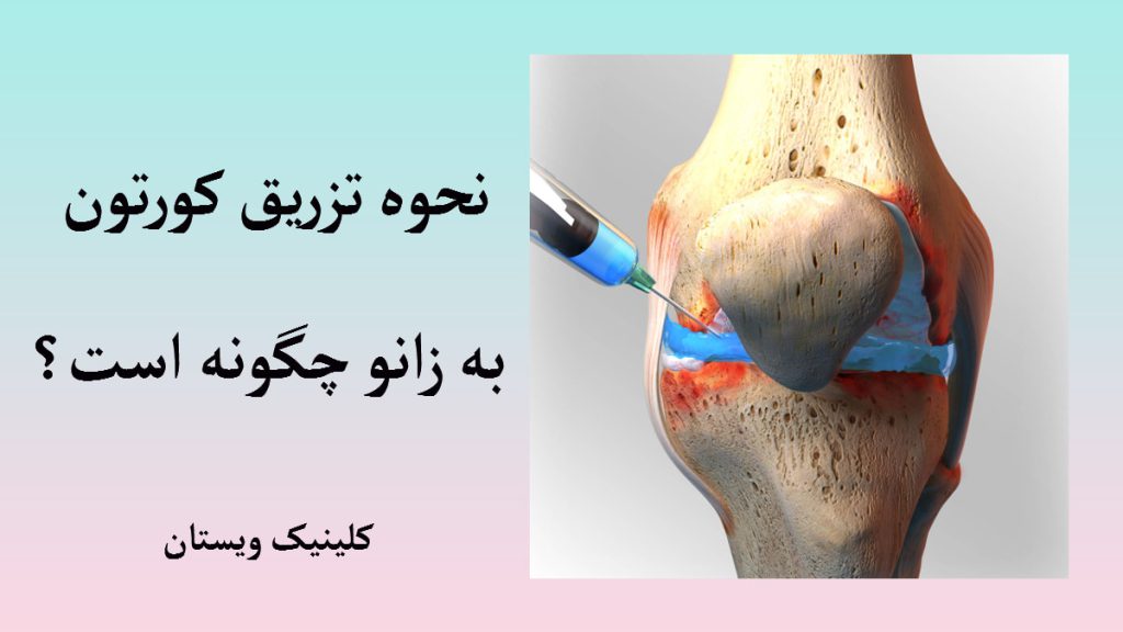 نحوه تزریق کورتون یک مفصل زانو که یک سرنگ در حال تزریق در آن دیده می شود