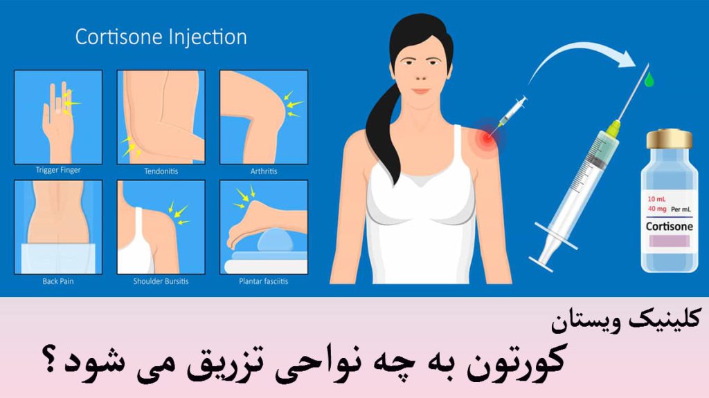 نواحی تزریق کورتون چند تصویر در کنار هم از نواحی تزریق کورتون در بدن