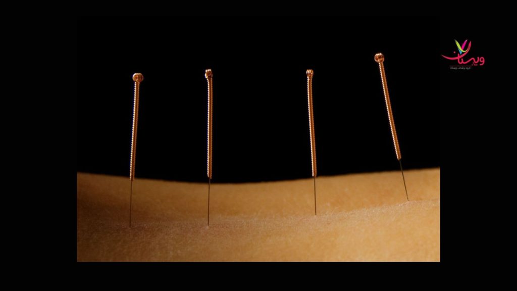 طب سوزنی برای دیسک کمر طب سوزنی برای دیسک کمر در تهران
