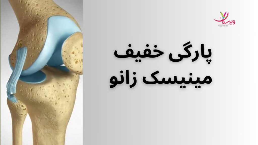 تقویت عضلات اطراف زانو پارگی خفیف مینیسک زانو