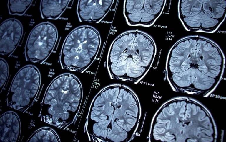 تشخیص صرع و تشنج از mri