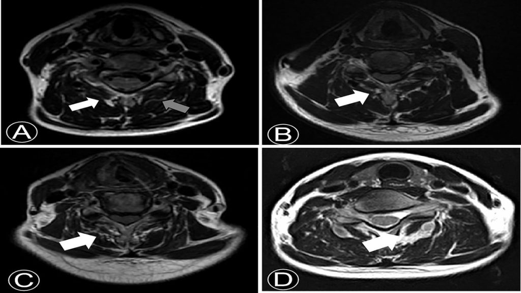 عضله scm تشخیص با MRI توسط دکتر شهربانو