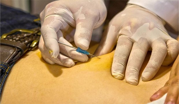 این روش کمتهاجمی و تقریباً بدون درد است. نخهای استفاده شده در امبدینگ باعث تحریک نقاط حساس بدن میشوند.