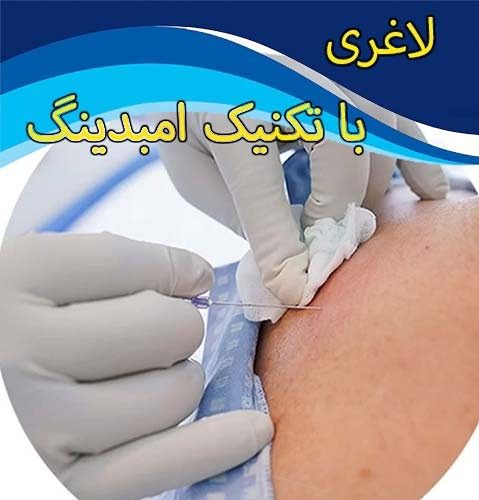 دکتر شهربانو متخصص امبدینگ امبدینگ میتواند به درمان سردردهای میگرنی کمک کند.
