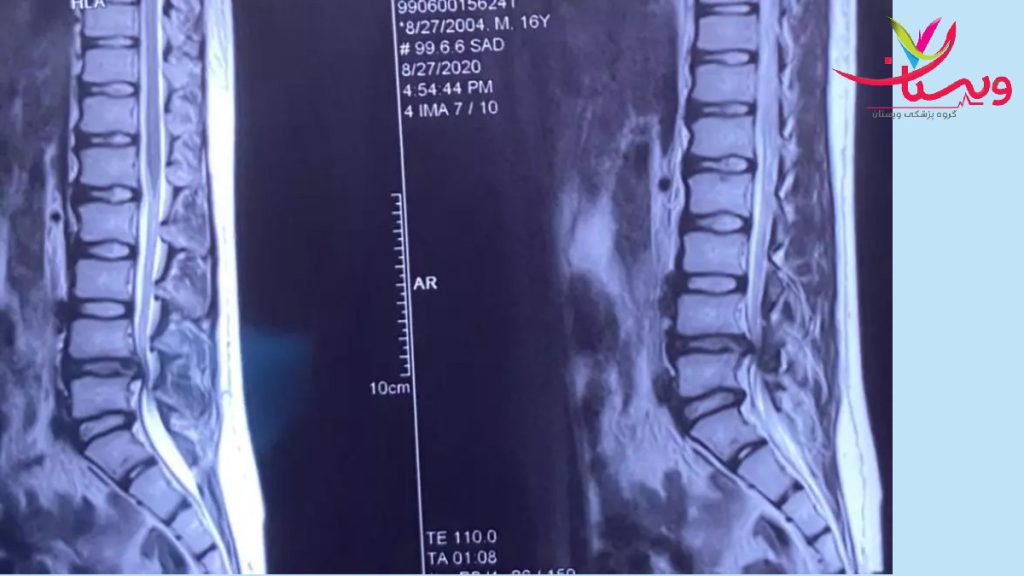 عوارض اسکنر برای بدن ام ار ای کمری که دچار اختلال ومشکل است