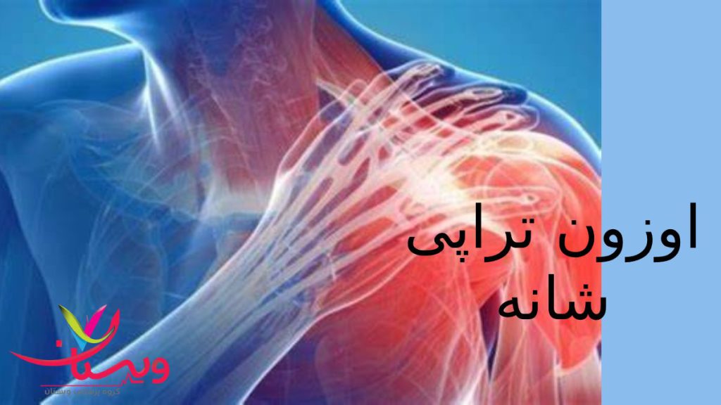 تزریق گاز اوزون به شانه برای بهبود عملکرد مفصل شانه فردی که دچار شانه درد است ودستش را روی شانه اش گذاشته