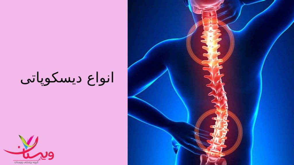 نمونه های مختلف دیسکوپاتی انواع دیسکوپاتی ✦ دیسکوپاتی کمری علائم✚دیسکوپاتی در سطح l4-5