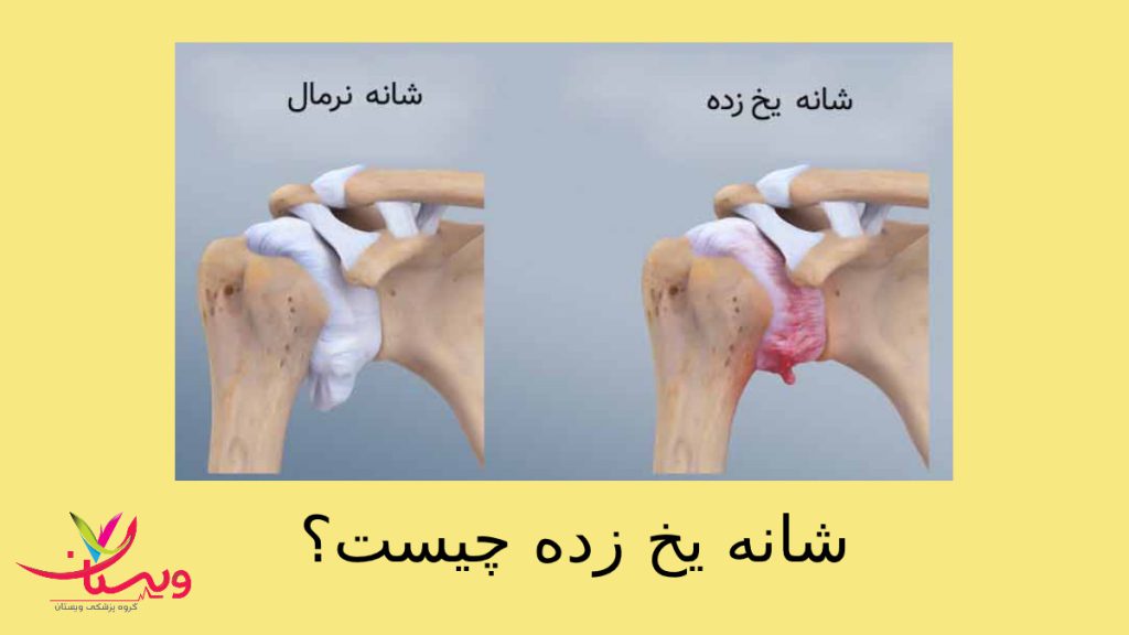 کپسولیت چسبنده شانه یخ زده یعنی چی؟ علائم ✚ بهترین دارو برای شانه یخ زده✔