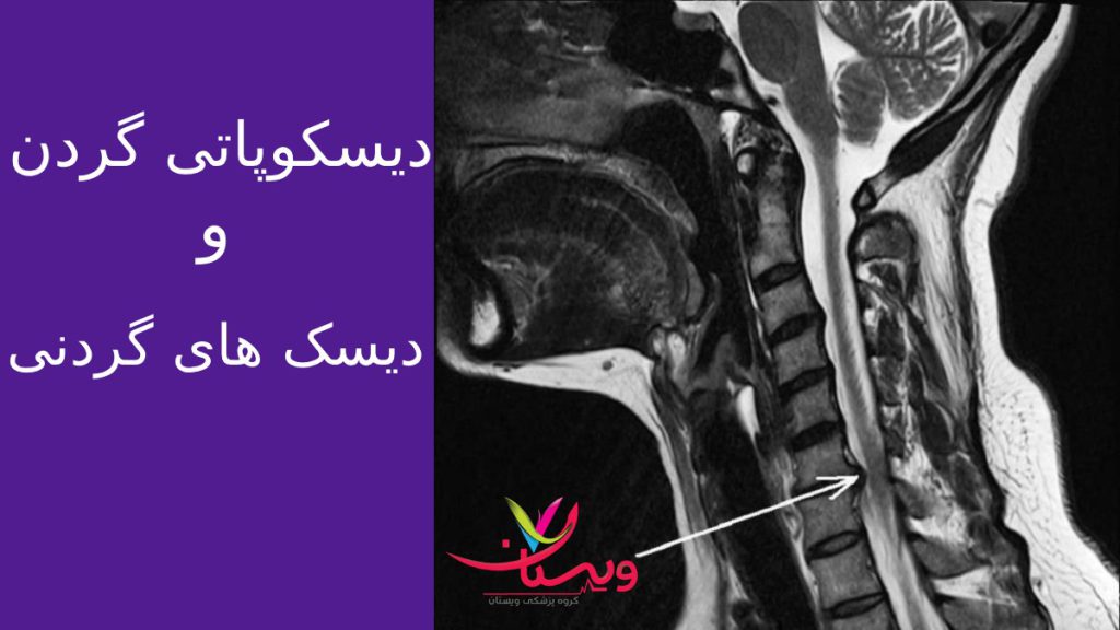 دیسک گردن عکس رادیو گرافی از گردن بیمار برای تشخیص بیماری