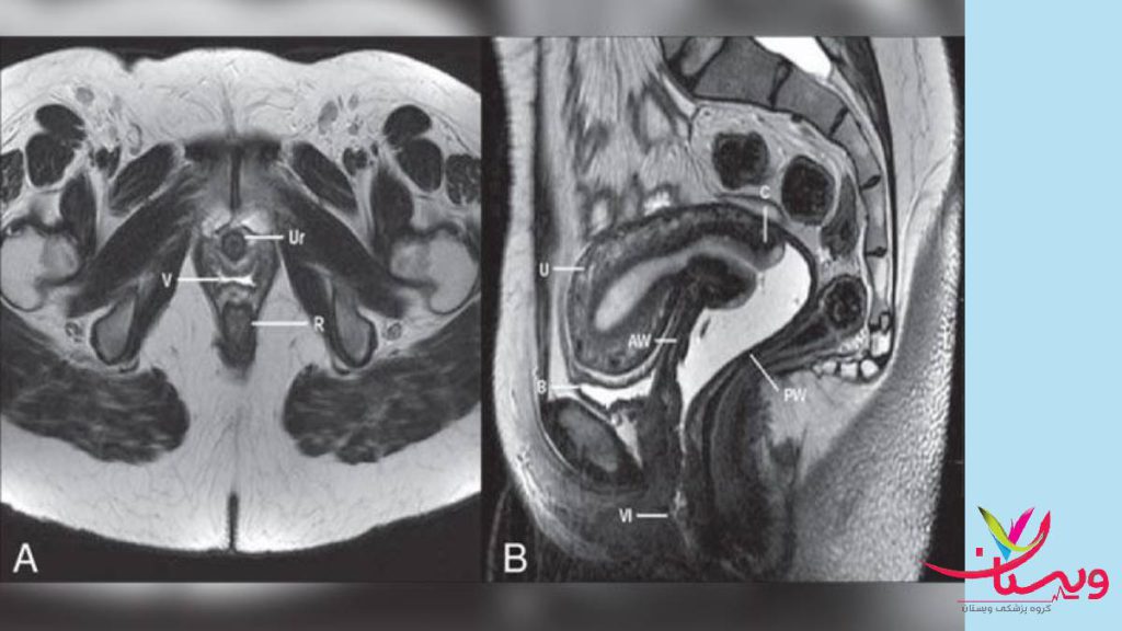 ام ار ای کمر ولگن با تزریق چه مزایا ومعایبی دارد ام ار ای کمر ولگن که برای وضوح بیشتر تصویر از تزریق ماده حاجب استفاده شده است