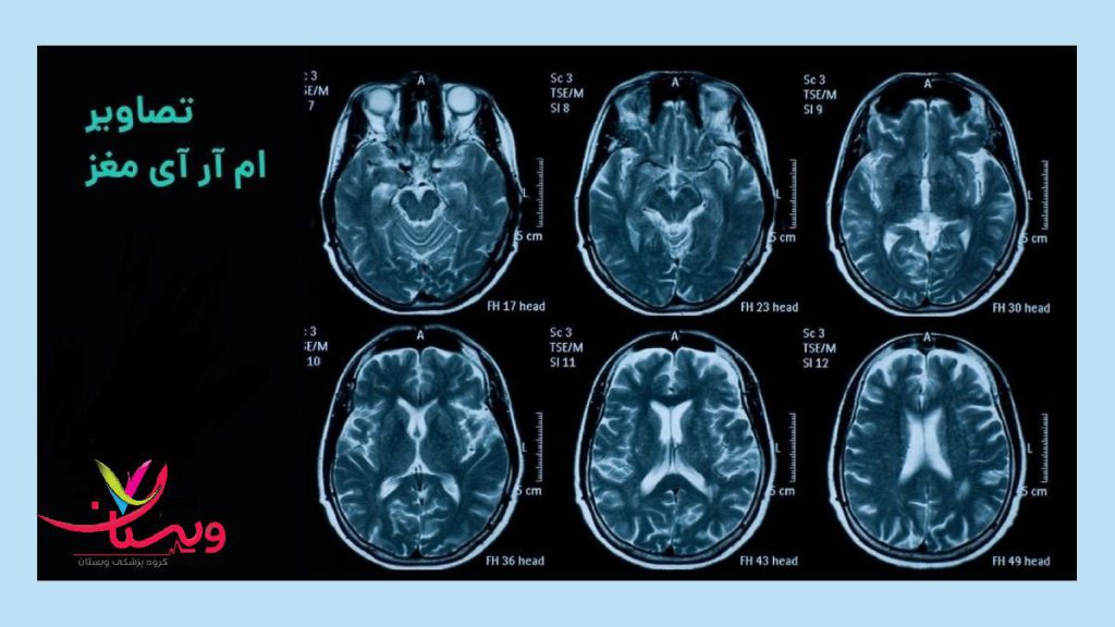 ام آر آی مغز برای چه اختلالاتی تجویز می شود ام ار ای مغز که برای تشخیص بیماری باید تفسیر شود