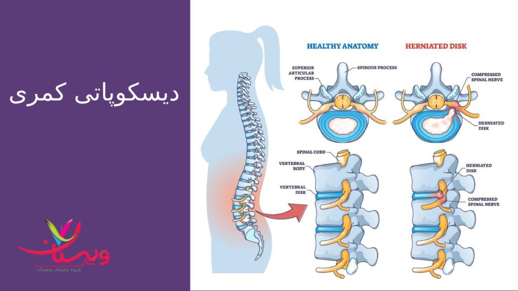 فتق دیسک کمر خانمی که دچار درد ستون فقرات است