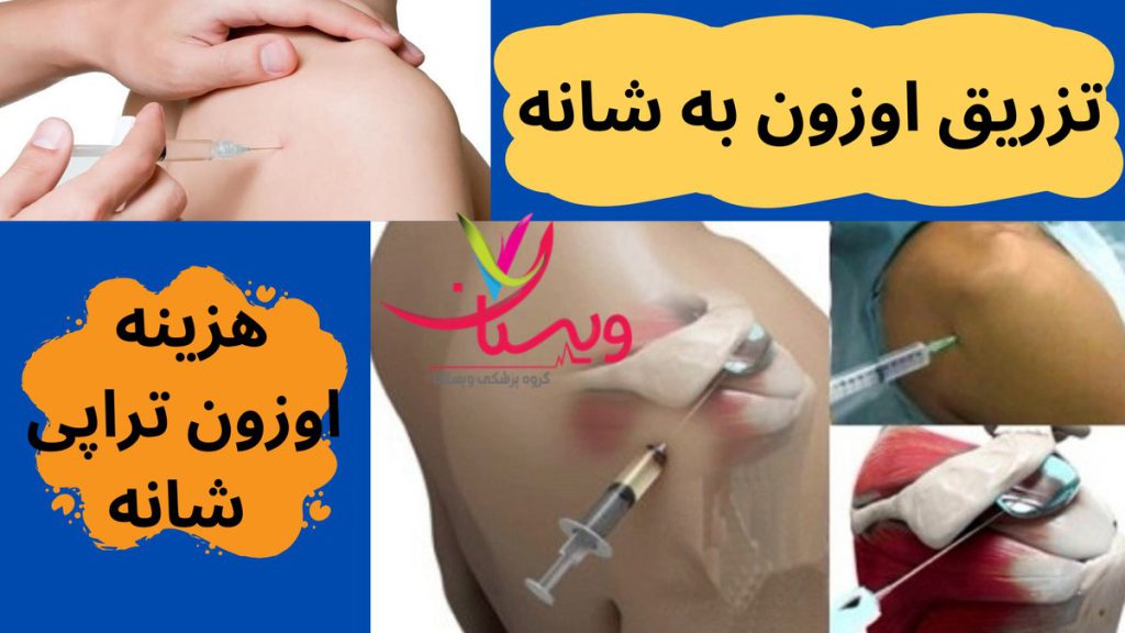 هزینه اوزون تراپی شانه 1404