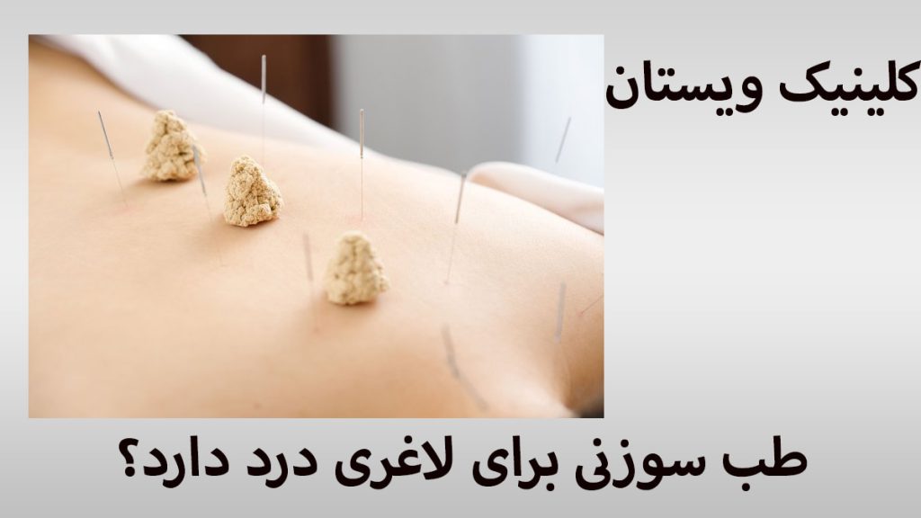 درد طب سوزنی طب سوزنی شکم