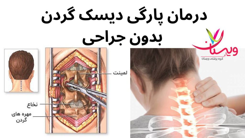 درد ناشی از فشار دیسک درمان پارگی دیسک گردن بدون جراحی