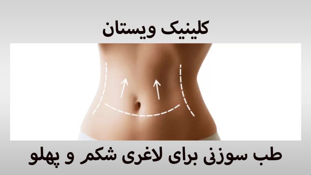 طب سوزنی برای لاغری شکم شکم یک خانم که با خط کشی مشخص شده است