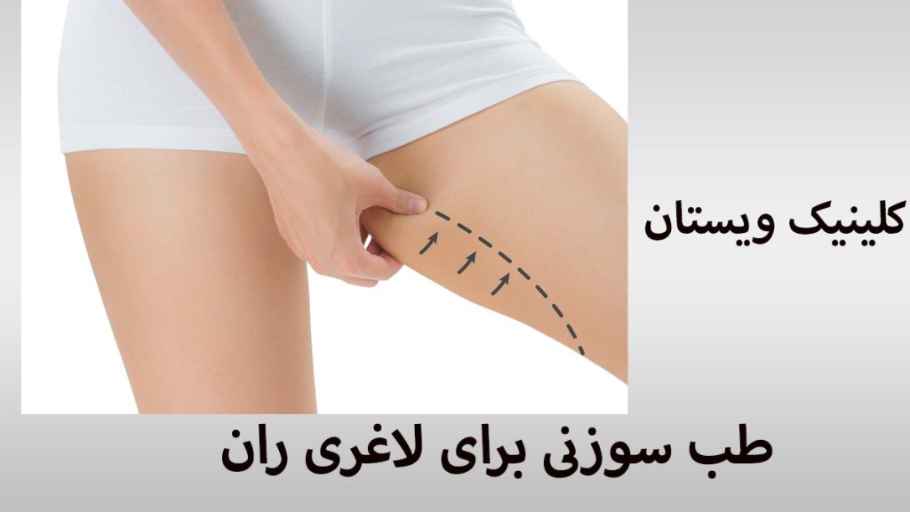قسمت ران یک خانم با ماژیک برای طب سوزنی ران مشخص شده است-نوشته : طب سوزنی برای لاغری ران