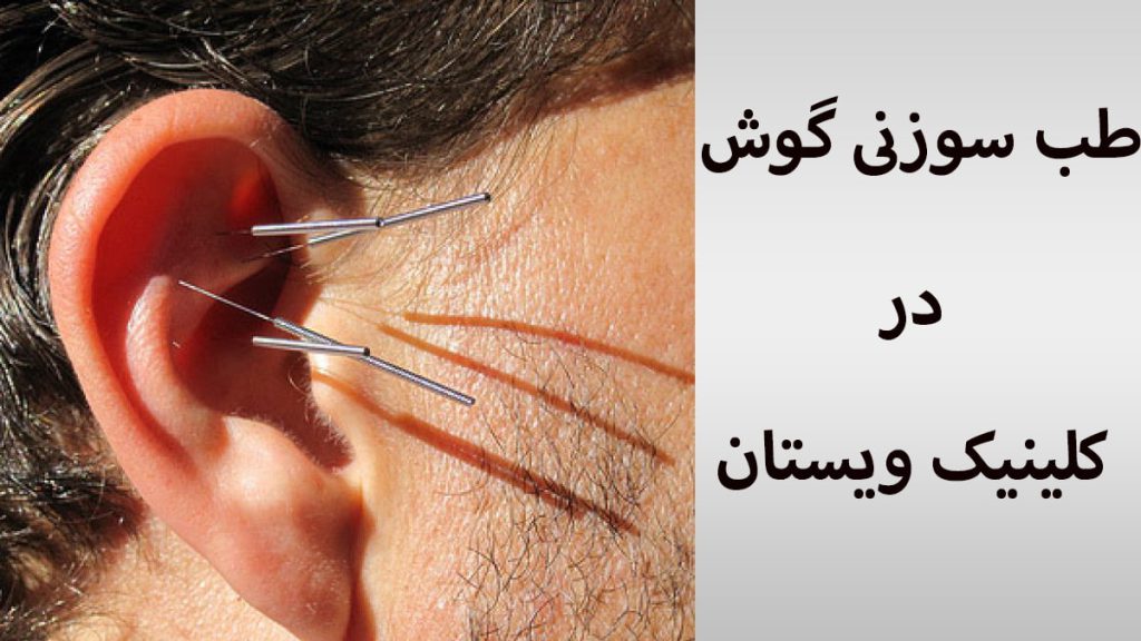 طب سوزنی گوش طب سوزنی گوش