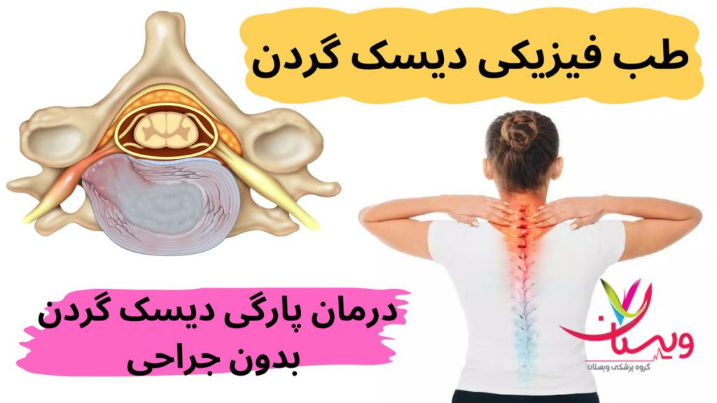 درمان پارگی دیسک گردن بدون جراحی